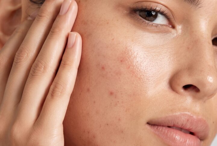 Woman gently touching her cheek to check flat post-acne marks